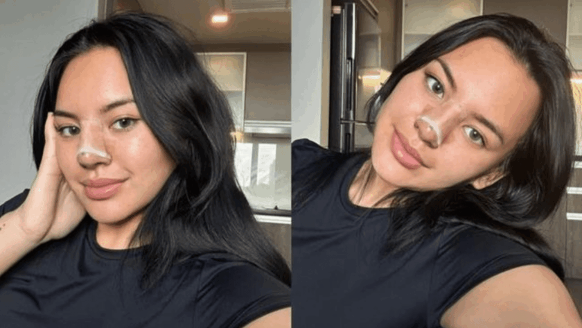 Shafa Harris Open Revision Rhinoplasty