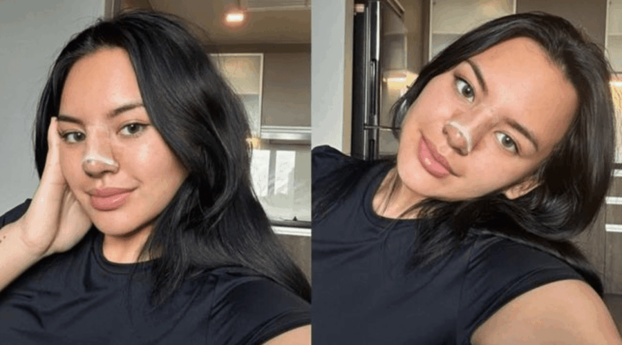 Shafa Harris Open Revision Rhinoplasty