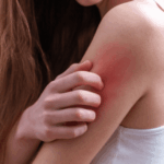 Penyebab Kulit Sensitif