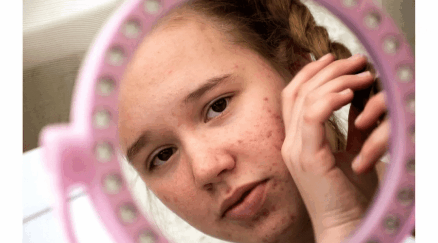 Jerawat Pengaruhi Mental