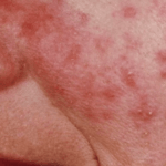 Perburukan Rosacea Hormon