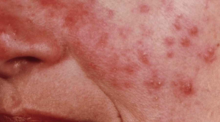 Perburukan Rosacea Hormon