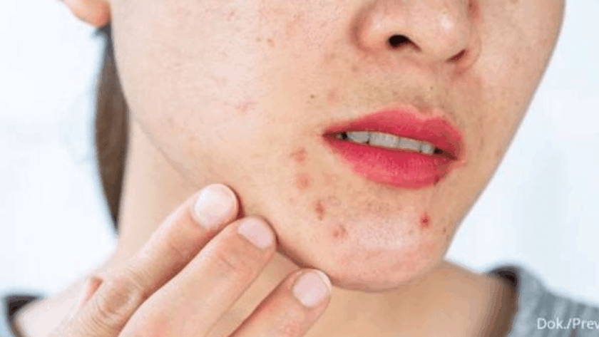 Letak Jerawat Wajah