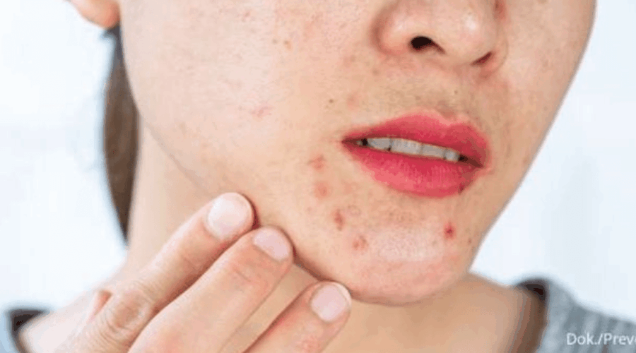 Letak Jerawat Wajah