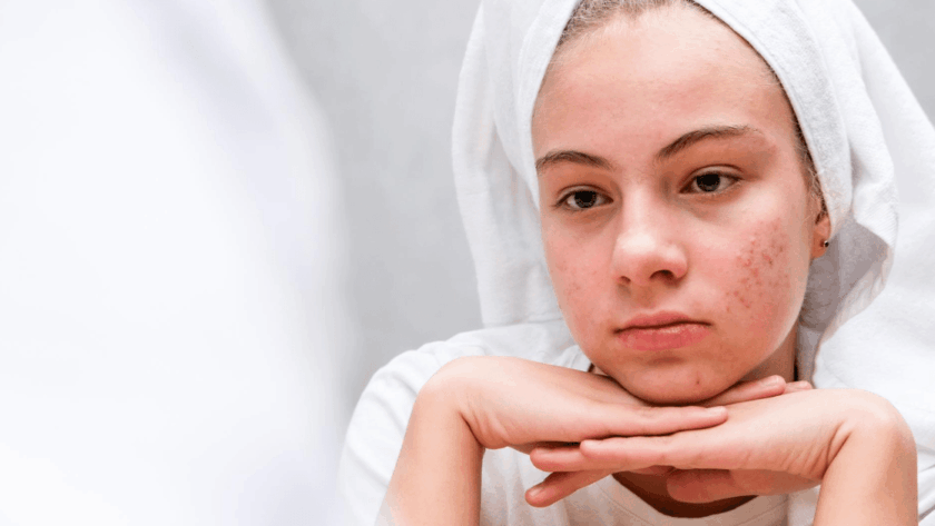 7 Penyebab Jerawat