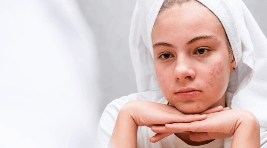 7 Penyebab Jerawat