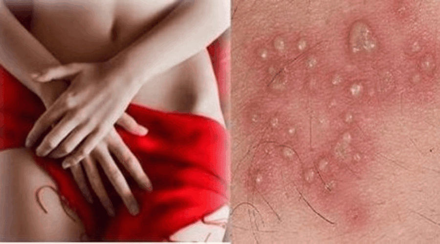 Penyebab Vagina Gatal