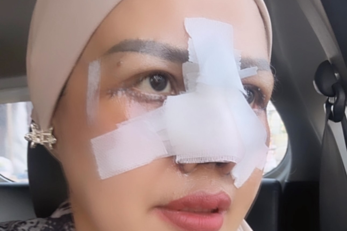 Elly Sugigi oplas: hidung dan mata Ilustrasi elly sugigi oplas untuk artikel Elly sugigi oplas: Elly Sugigi Jalani Oplas Hidung dan Mata,…